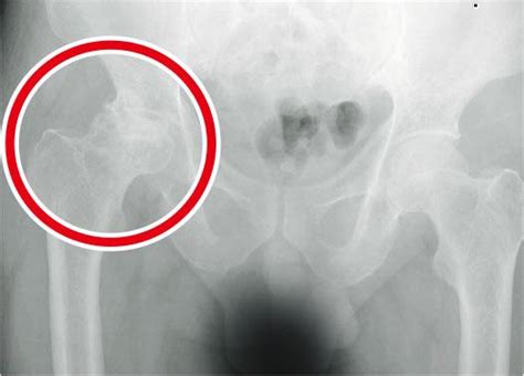 為什麼會骨枯|【髖關節炎】常見4大成因：關節退化、骨折 痛楚持續。